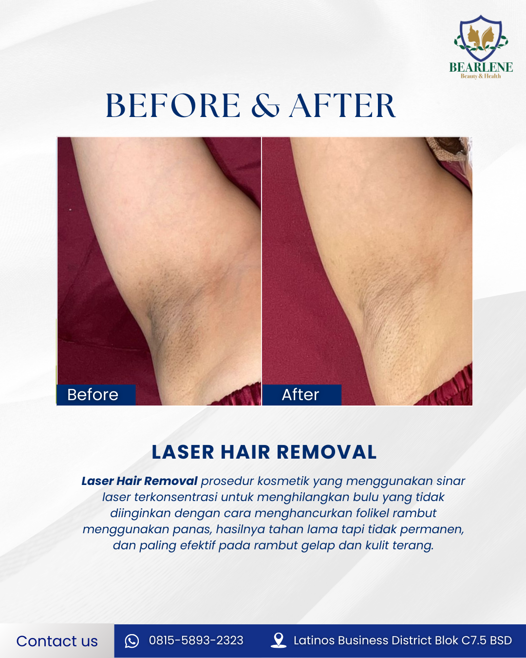 Before After Underarm Brightening