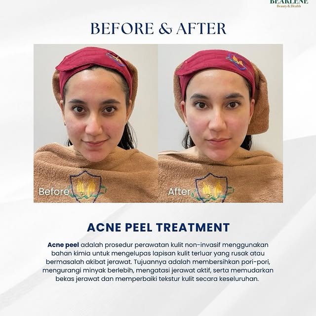 Before After Skinbooster